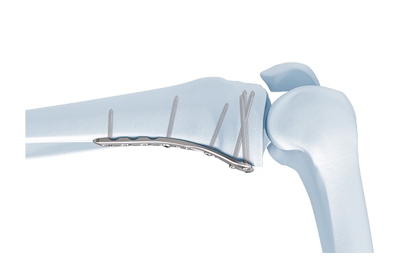 LCP Posterior Medial Proximal Tibial Plate 3.5